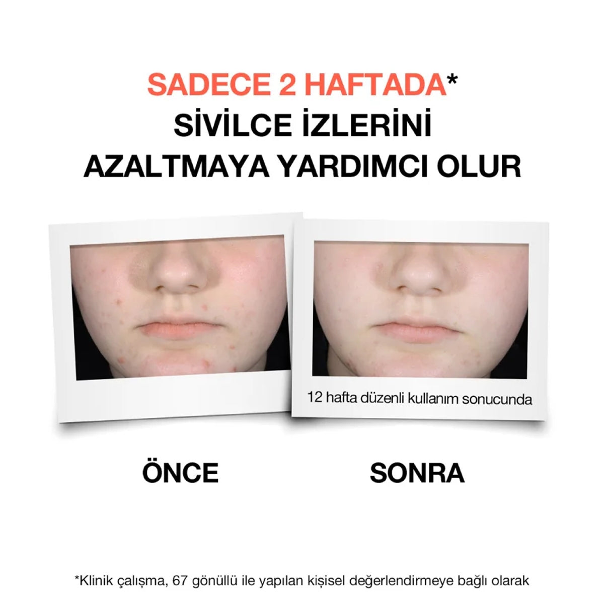 Sivilce Serumu 30 ml